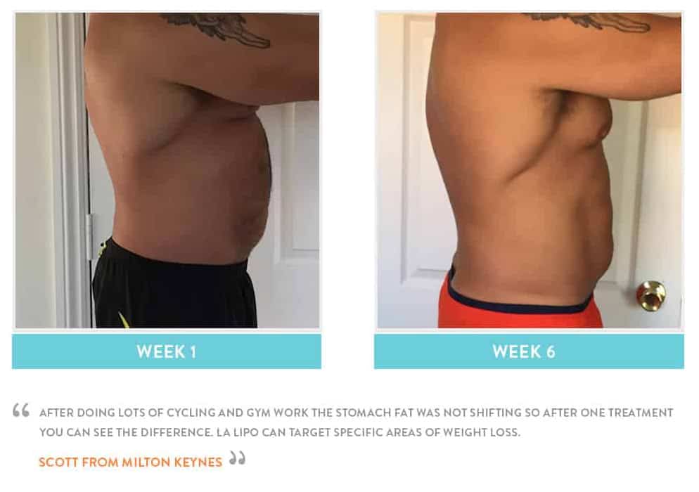 Before & After Stomach Fat Accrington