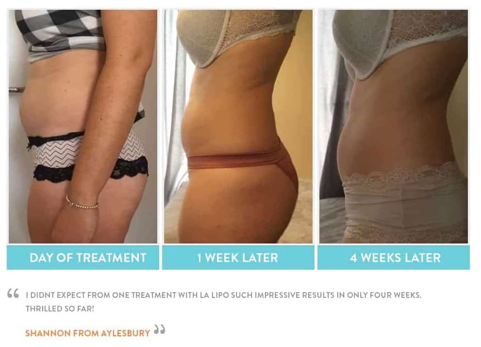 before, Cryolipolysis Accrington