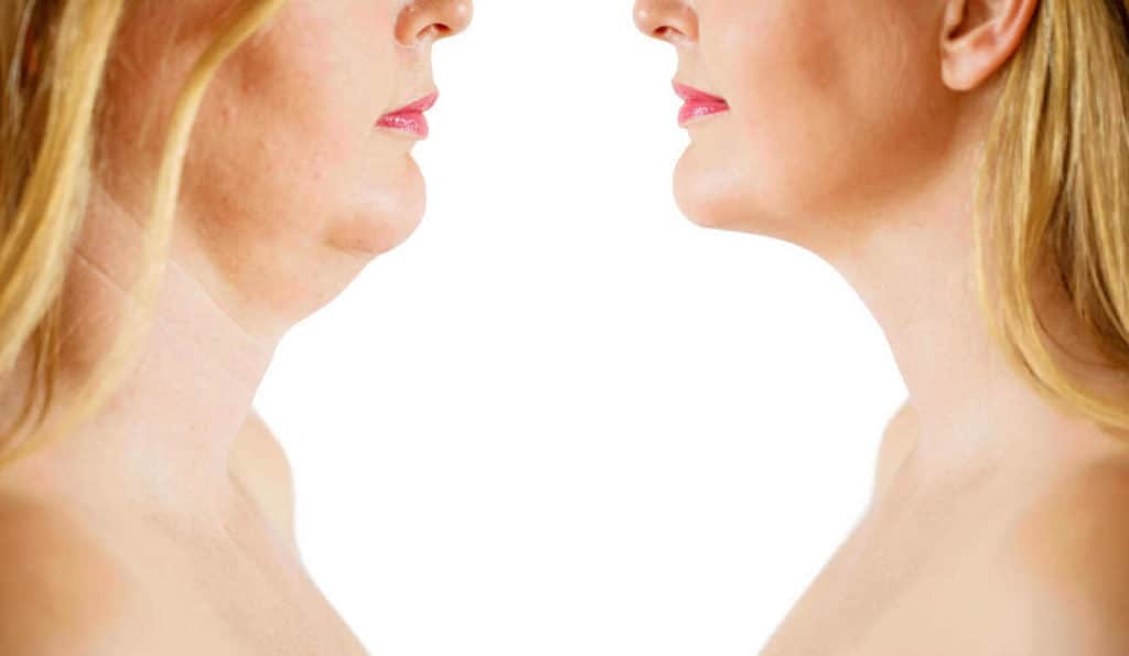 Double Chin treatment Accrington before and after results