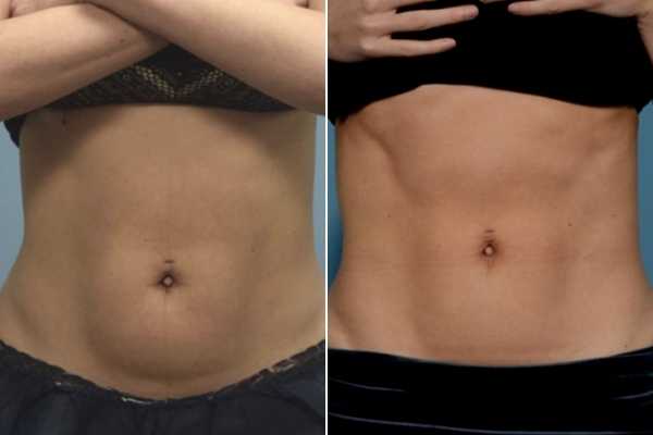 body sculpting FAQs Accrington