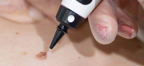 After Skin Tag Removal Accrington