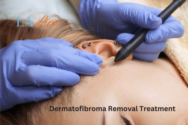 Dermatofibroma Removal Treatment Accrington