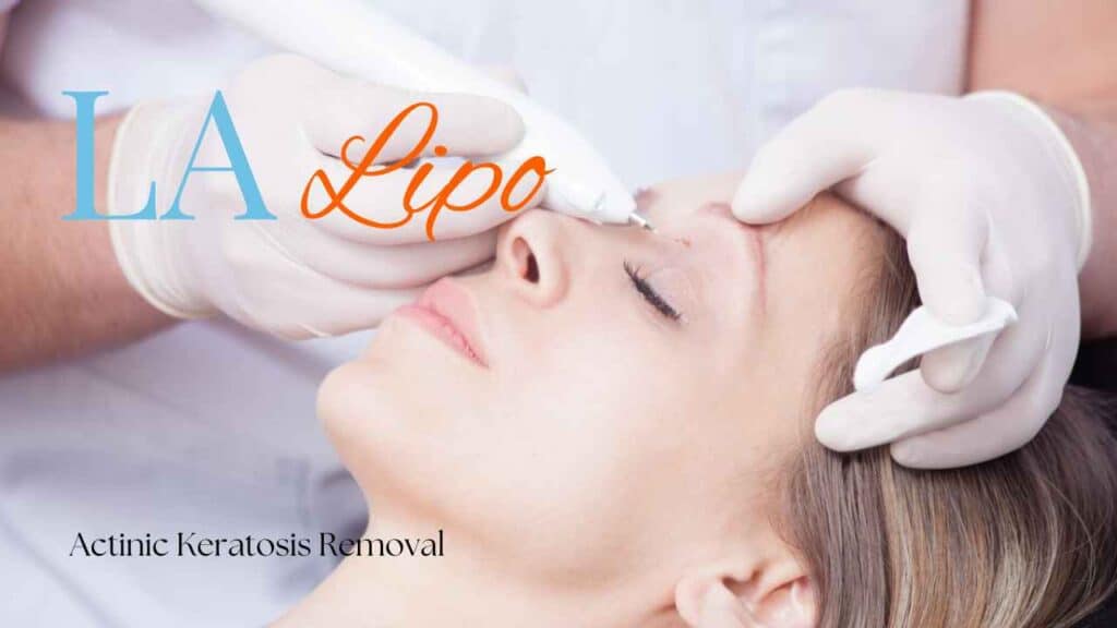 actinic keratosis removal Accrington