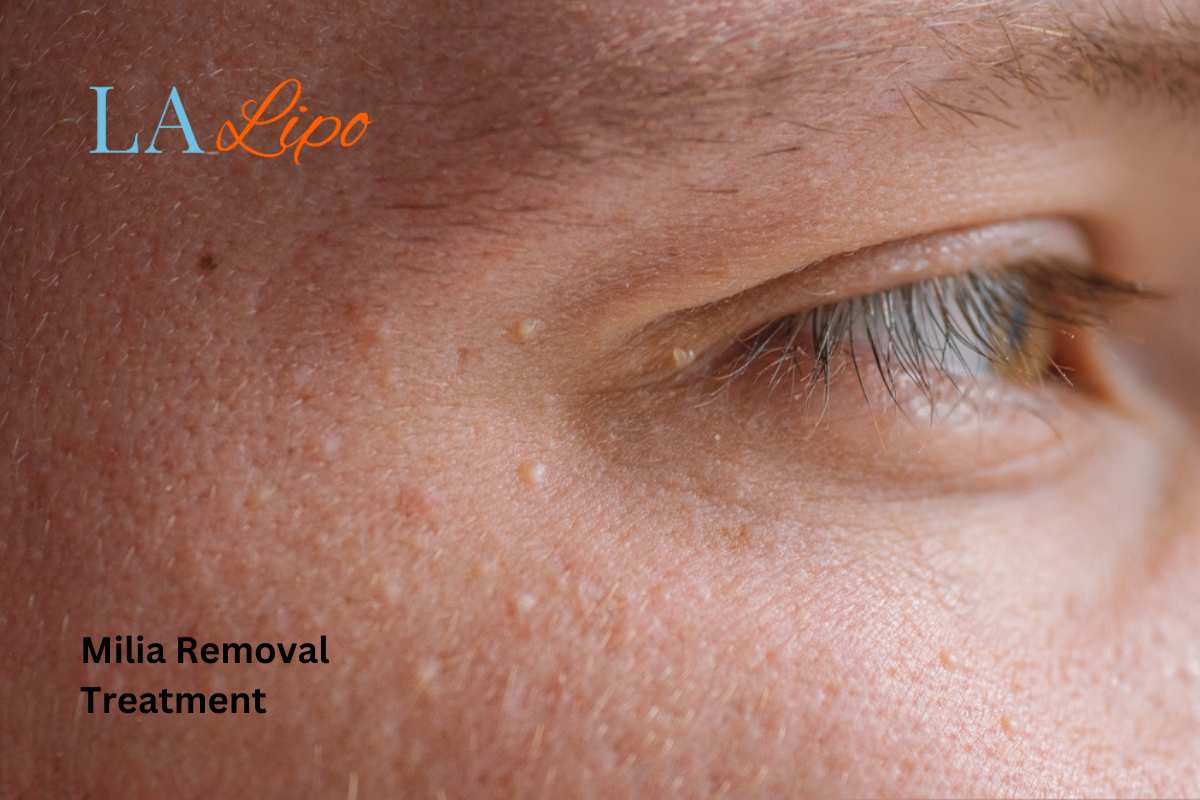 Cryopen Milia Removal: Is It the Easiest and Safest Option Accrington?