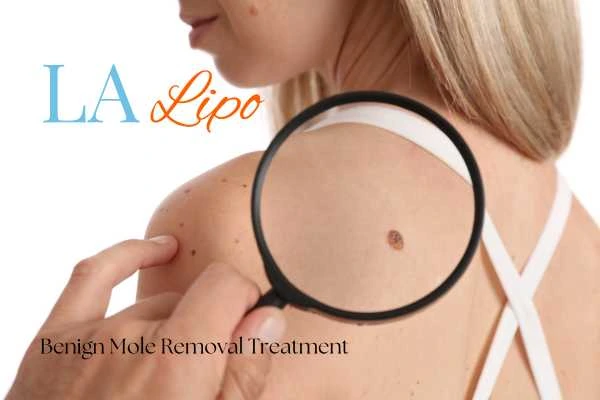 Why getting moles removed Accrington can boost your confidence!
