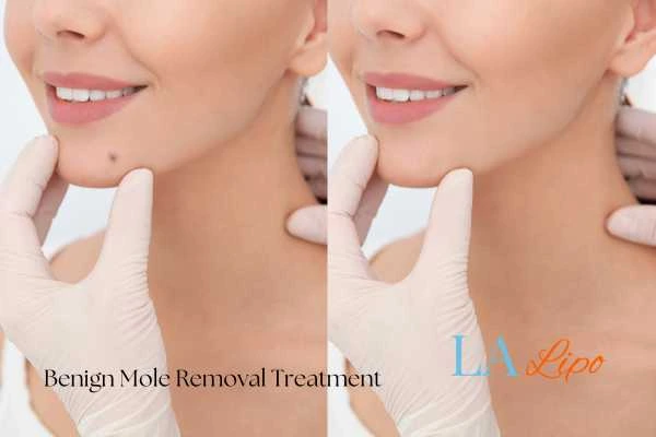 Woman's before and after results of being moles removal treatment Accrington
