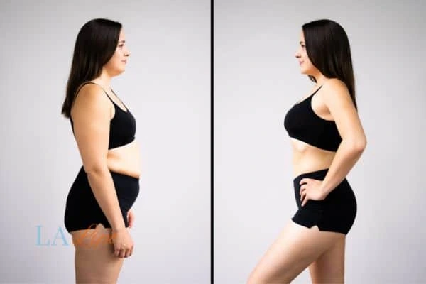 LA-EMS Body Sculpting Accrington results before and after of womans results on body toning.
