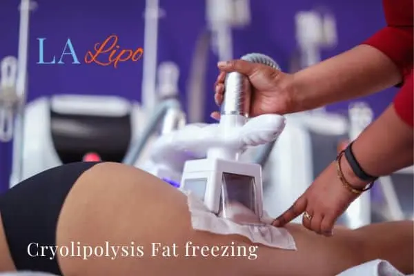 women getting fat freezing Accrington