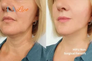 hi-fu for wrinkles Accrington before and after results