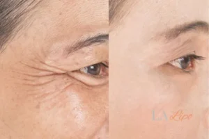 Before and after results of woman - HI-fu wrinkles reduction treatment Accrington