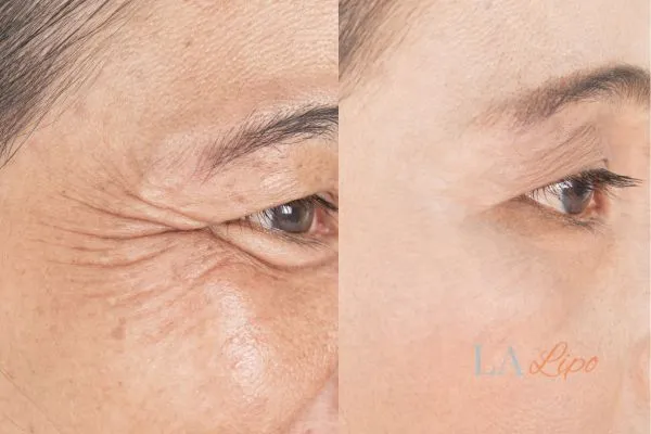 Before and after results of woman - HI-fu wrinkles reduction treatment Accrington