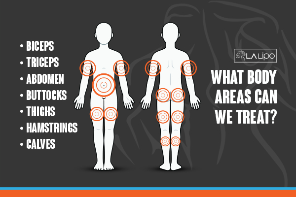 Graphic to show areas you can have LA-EMS Body Sculpting Accrington treatment.