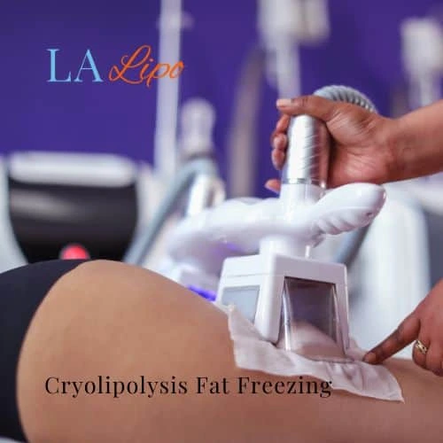 fat freezing - Cryolipolysis Accrington