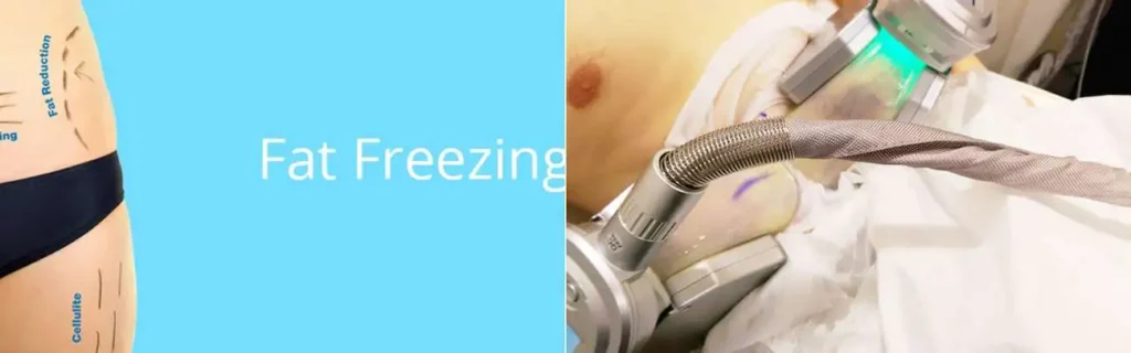multi areas of a persons body having coolsculpting Accrington treatment