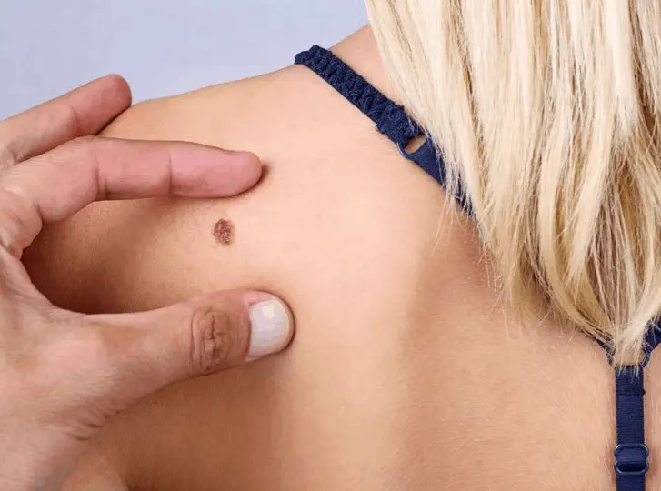 woman having mole removal Accrington consultation before treatment.
