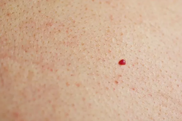 close up of a cherry angioma Accrington