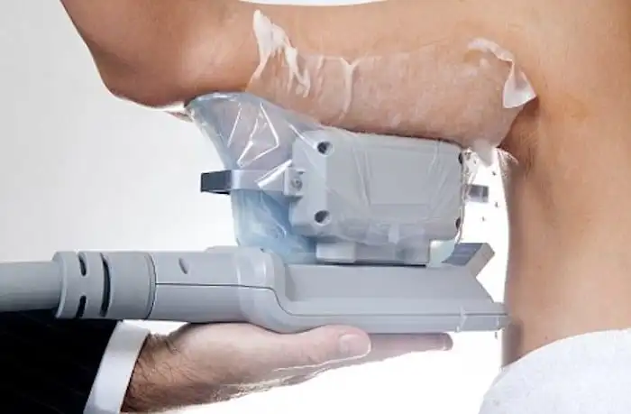 Picture of fat freezing Accrington on the upper arms.
