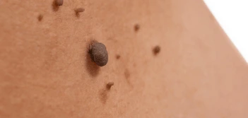 image of a skin tag Accrington