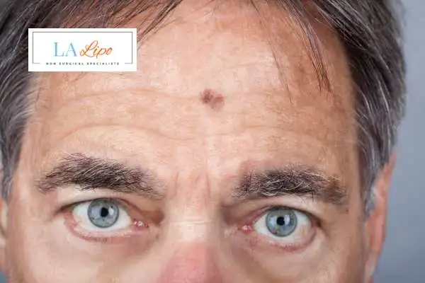 Solar Lentigo Removal Accrington image of man with mark on his forehead