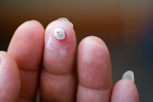 wart on person finger - cryotherapy to treat from LA LIPO Accrington