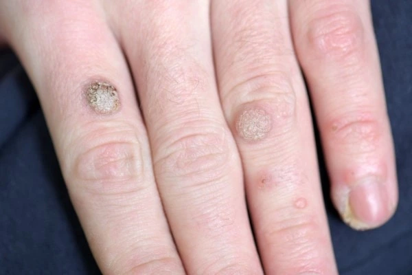 photo of warts on person hand - see wart removal Accrington from LA LIPO
