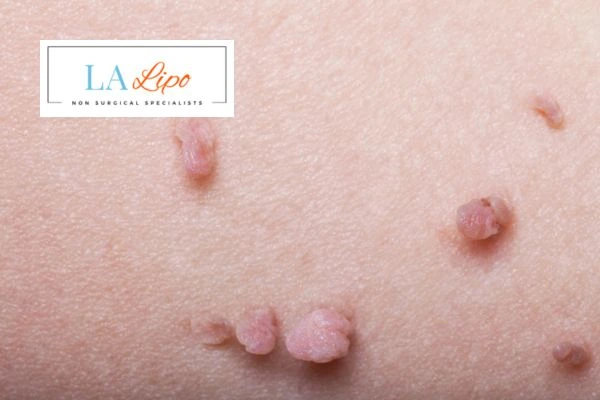 Does cryopen skin tag removal Accrington hurt? Find out now call our team today!