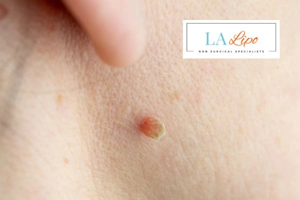 Book skin tag removal Accrington today speak to our team now!