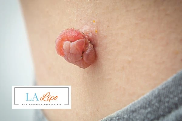 Interested in skin tag removal Accrington? Concerned about the pain? Find out more today!
