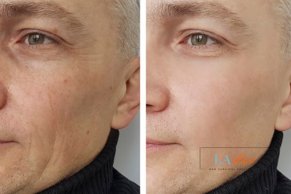 See the amazing results of Morpheus8 Treatment Accrington!