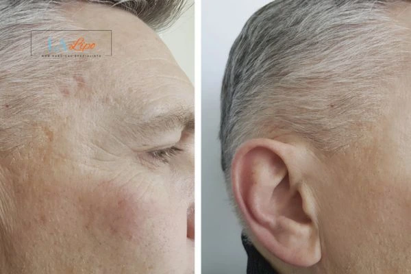 Mens Before & After Morpheus 8 Results Accrington