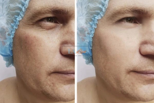 Before and after Morpheus 8 Results Accrington