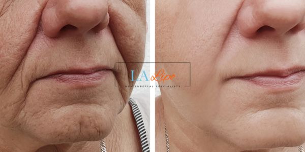 Older lady deeper wrinkle reduction - LA LIPO Morpheus 8 Results Accrington