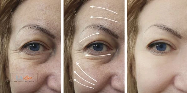 Amazing eye lift Morpheus 8 results Accrington