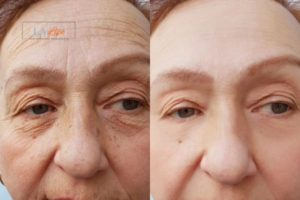 The powerful benefits of Morpheus8 Treatment Accrington - Call Our team today!