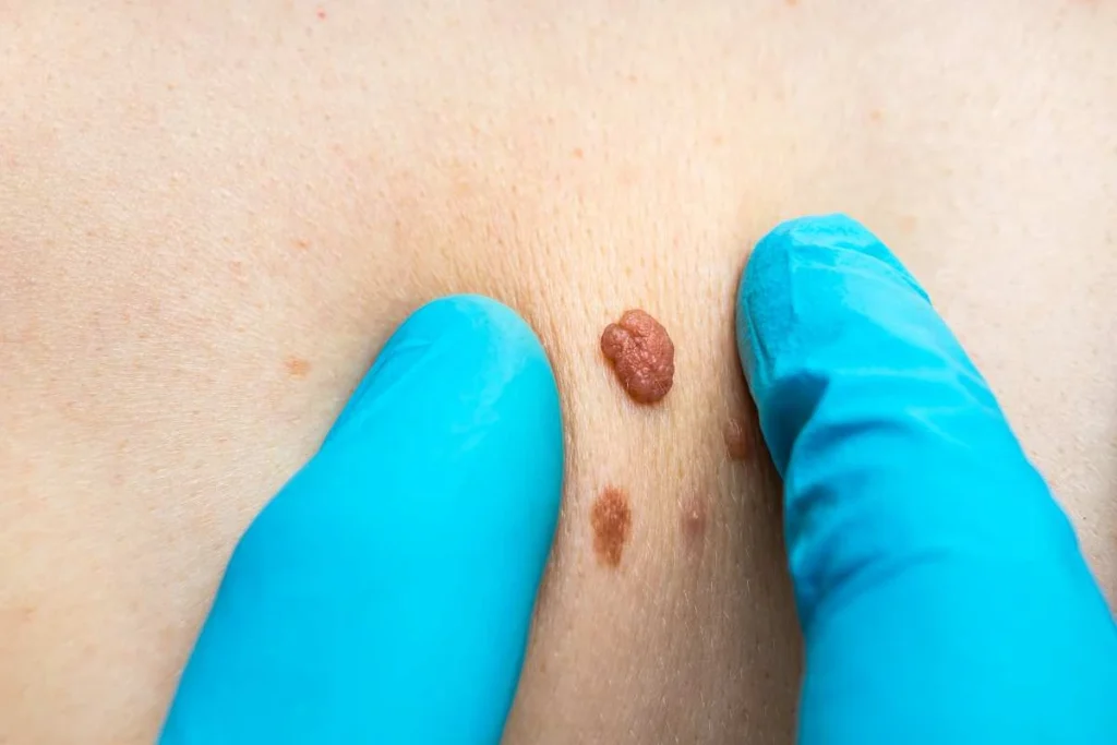 LA LIPO Cryopen Lesion Removal Prices Accrington
