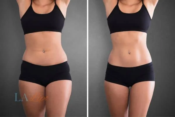 before and after results of non-surgical treatment to help a woman's body image and mental health Accrington