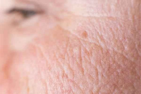 close up picture of a woman's face showing an age spot Accrington