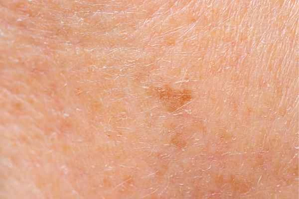 close up picture of age spots Accrington