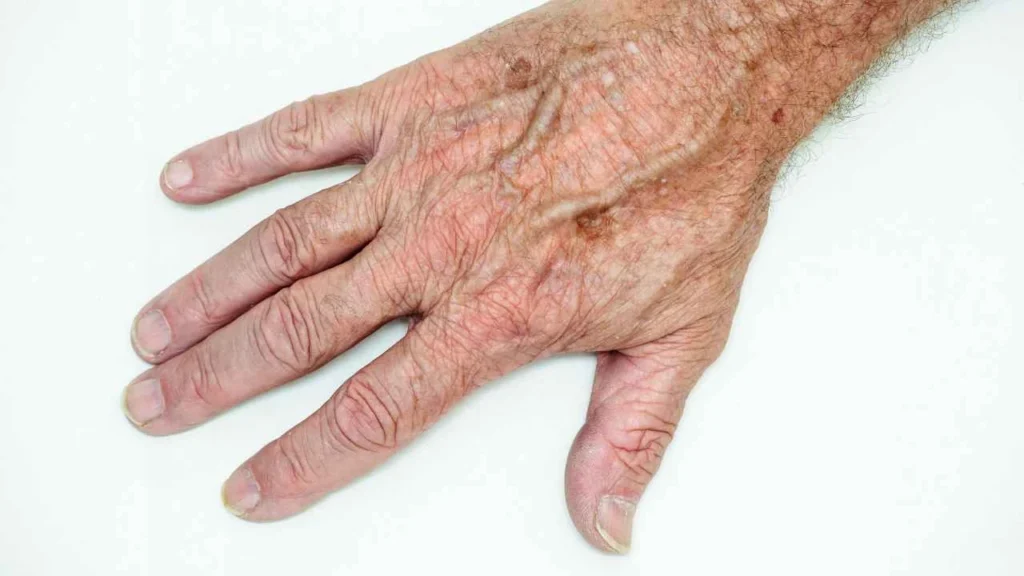 Male hand showing age spot Accrington
