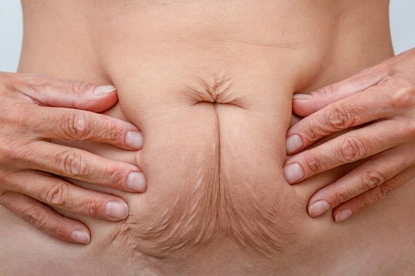Image of a woman's stomach with loose skin - example of skin tightening Accrington options