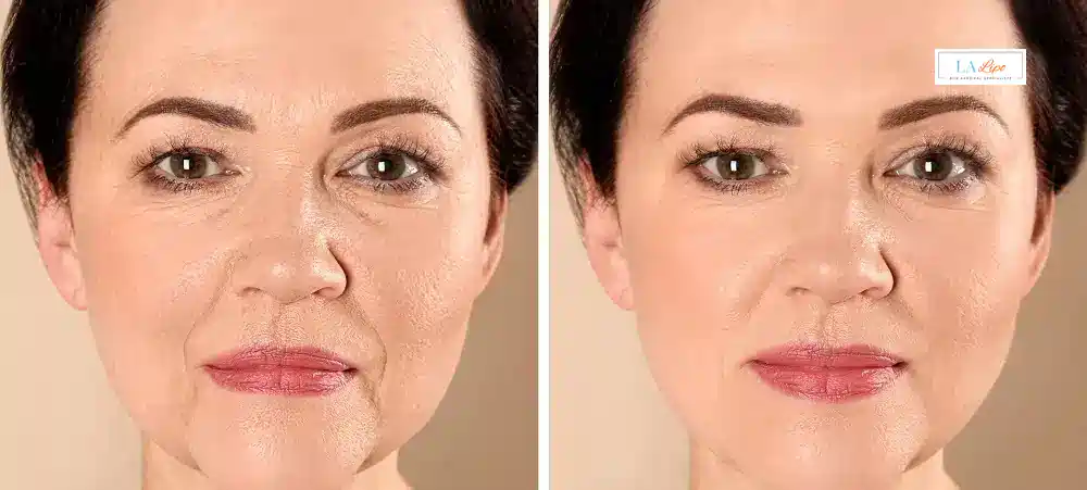 How Long Does It Take to See Results and How Long Do They Last Accrington?